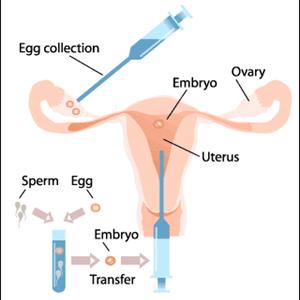 Track My Ovulation - IVF Procedure - The Basics One Needs To Know